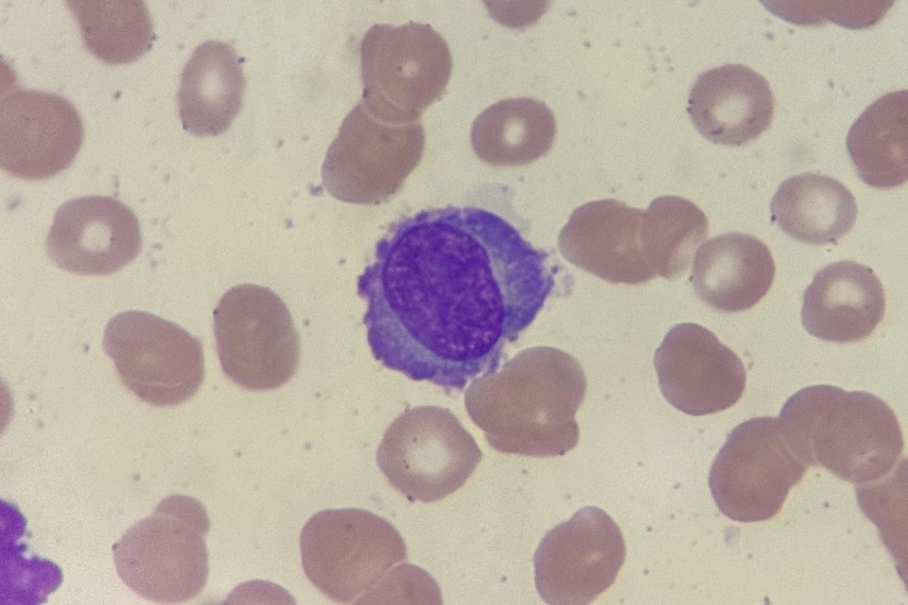 Plasmacytic Leukemia: Plasma Cells in Peripheral Blood Smear