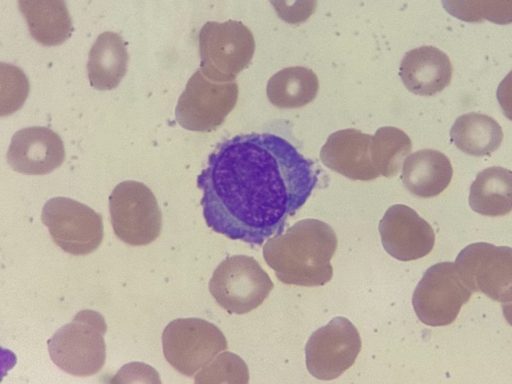 Blood smear: plasma cell with basophilic cytoplasm