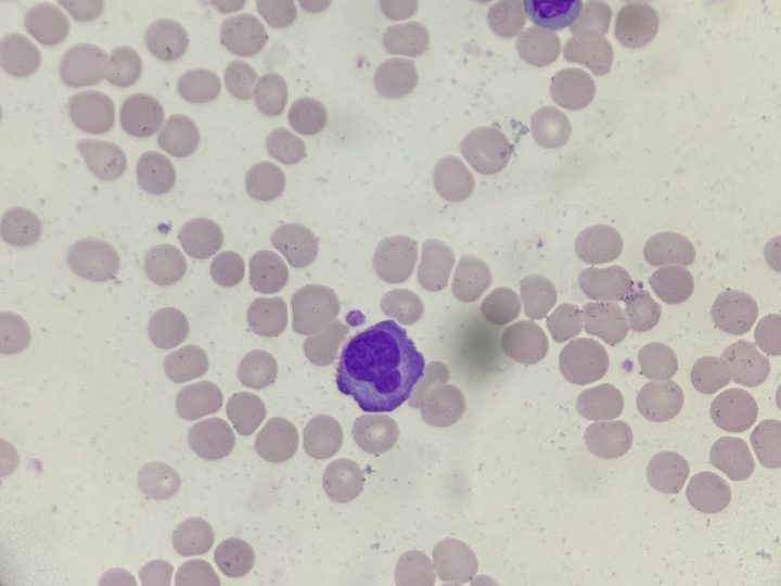 Blood smear: plasma cells amidst rouleaux formation