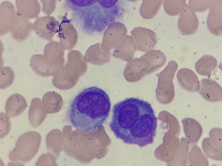 Blood smear: binucleated plasma cell and atypical forms