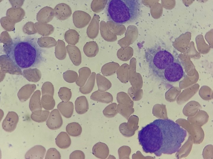 Blood smear: polymorphism of plasma cells, a binucleated cell is visible