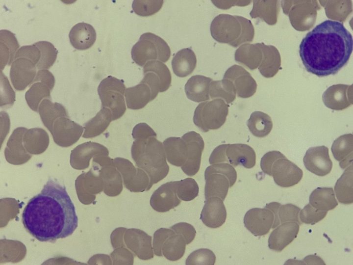 Blood smear: plasma cells and pronounced erythrocyte rouleaux