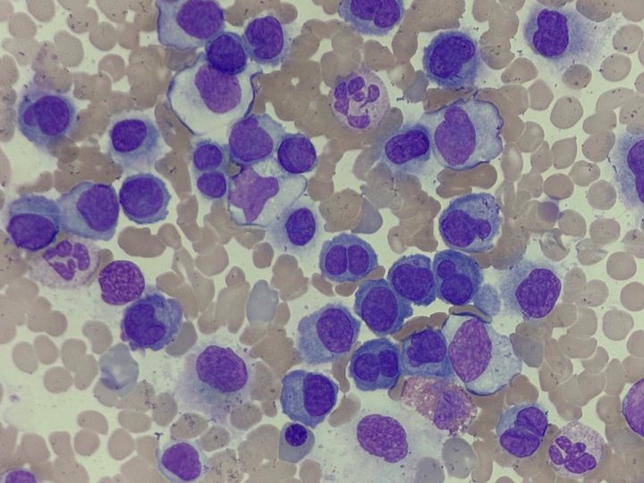 Smear: pronounced infiltration with atypical plasma cells