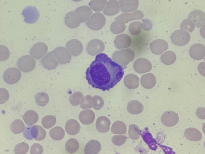 Blood smear: plasma cell and cytolysis nearby