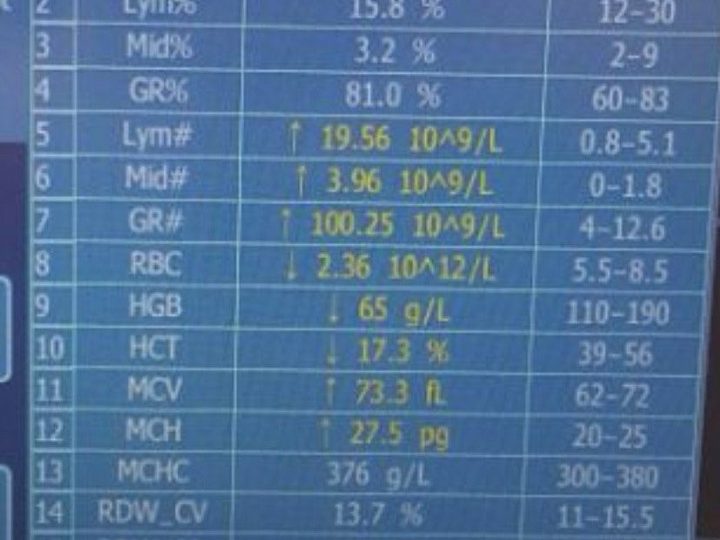 Экран гематологического анализатора: выраженный лейкоцитоз WBC 123,77×10⁹/л и анемия