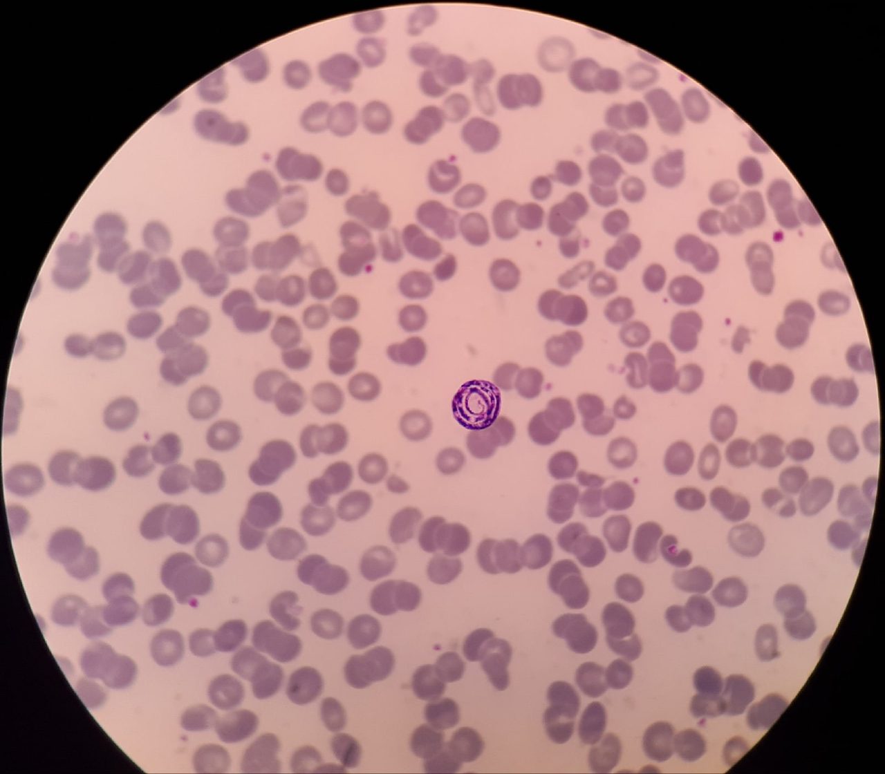 Microfilariae Suspicion vs. Artifacts in Blood Smear