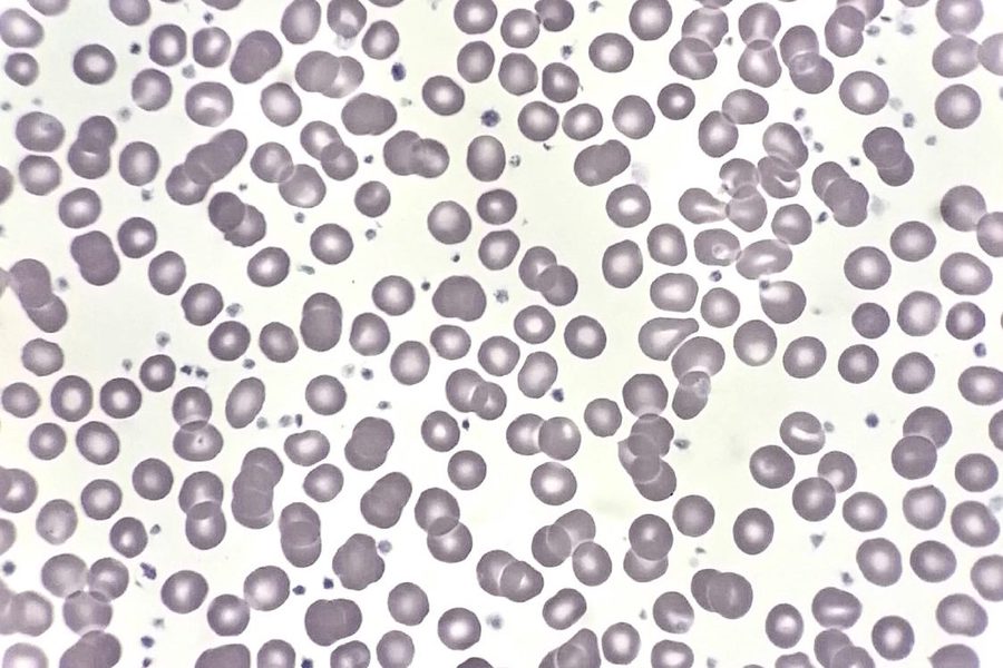 Fonio Platelet Count in Severe Thrombocytosis