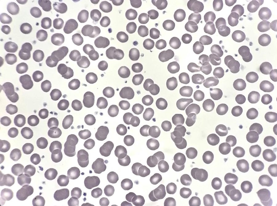 Fonio Platelet Count in Severe Thrombocytosis