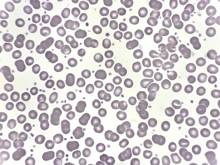 Blood smear, severe thrombocytosis, platelet clumps among erythrocytes