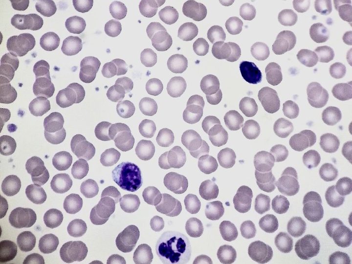 Blood smear, thrombocytosis, segmented neutrophil and mononuclear cells