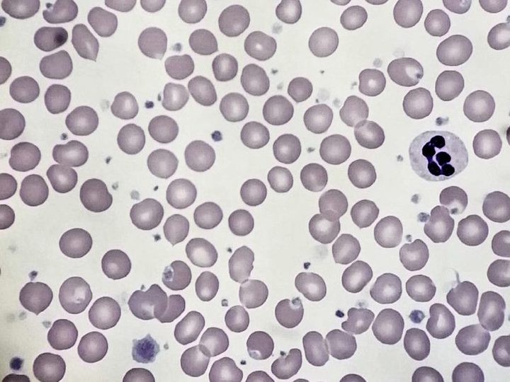 Blood smear, anisocytosis of platelets and segmented neutrophil