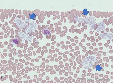 Blood smear, blue arrows indicate large platelet aggregates at the edge