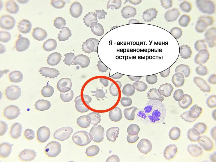 Мазок крови: акантоцит с неравномерными выростами цитоплазмы крупным планом