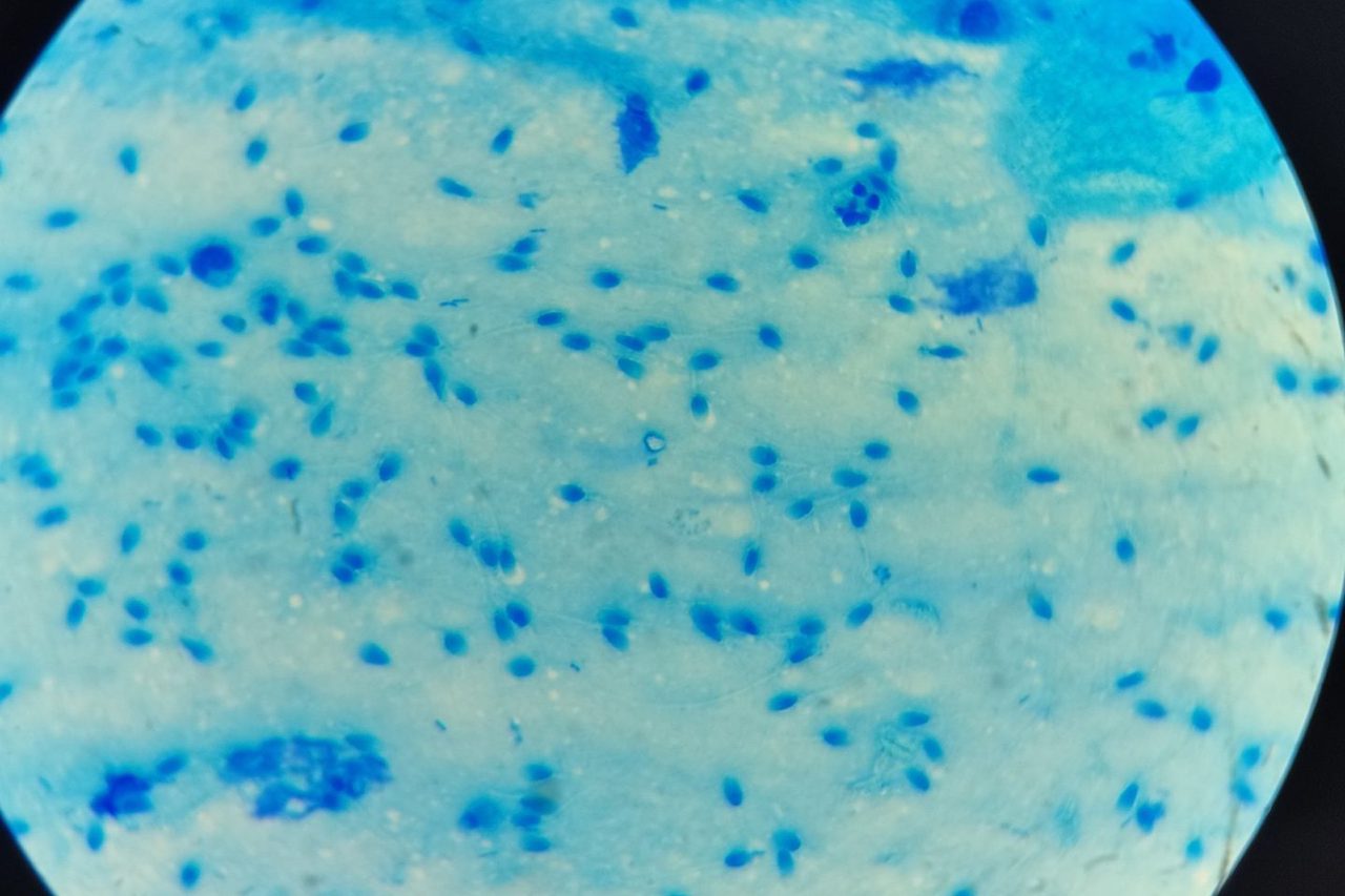 Preanalytics of a Flora Smear: Spermatozoa in the Sample