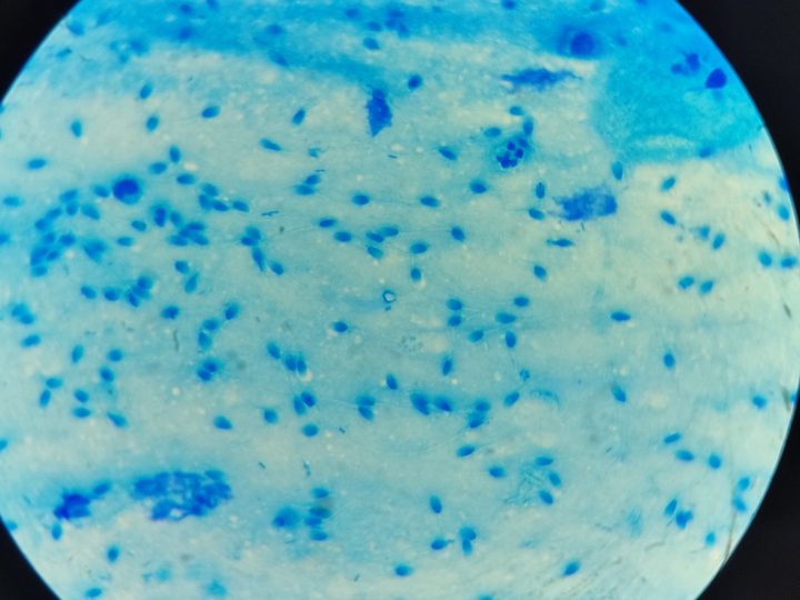Microscopy of a flora smear with a large number of spermatozoa