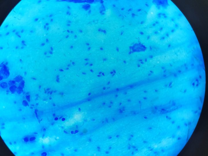 Stained discharge smear: spermatozoa cover the entire field of view