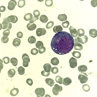Bone Marrow Promyelocytes in Autoimmune Neutropenia