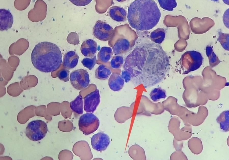 Gaucher-like Cells in Bone Marrow Smear in CML