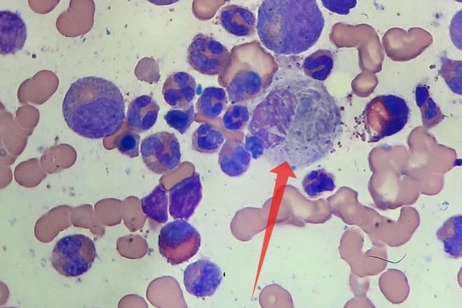 Gaucher-like Cells in Bone Marrow Smear in CML