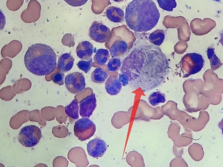 Bone marrow smear, large Gaucher-like cell indicated by arrow
