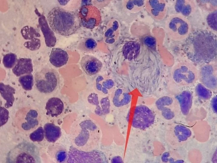 Bone marrow smear, Gaucher-like cell with fibrillar cytoplasm