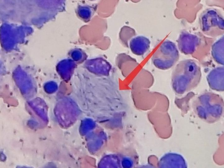 Bone marrow smear, macrophage with characteristic folded structure