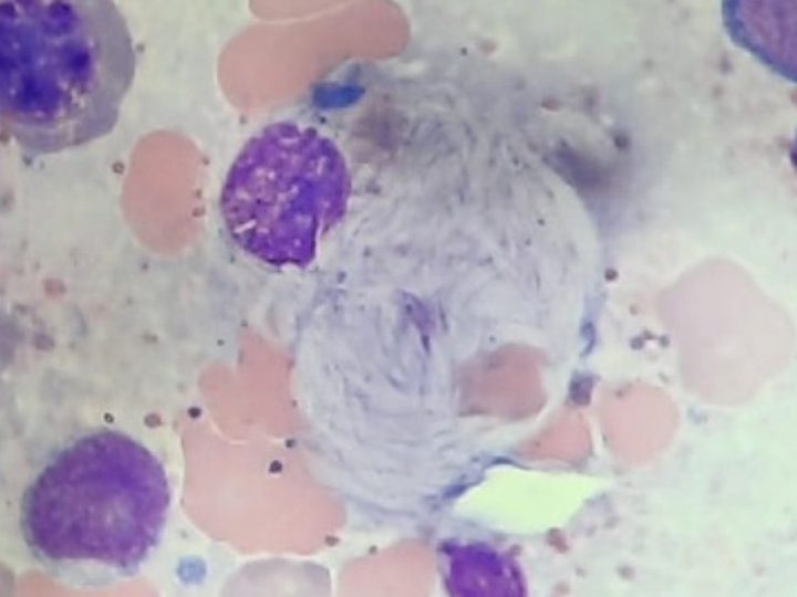 Bone marrow smear, Gaucher-like cell at high magnification
