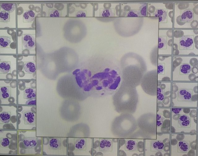 Neutrophil Hypersegmentation Amid Hyposegmentation in MDS