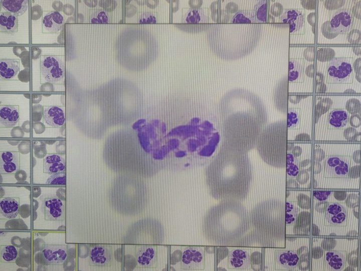 Digital blood smear: neutrophil nuclear hyposegmentation and hypersegmentation in suspected MDS