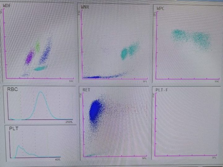 WDF, WNR, WPC, and RET scattergrams from a hematology analyzer in MDS
