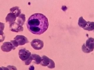 Мазок крови, пельгероидный нейтрофил с двумя симметричными сегментами ядра