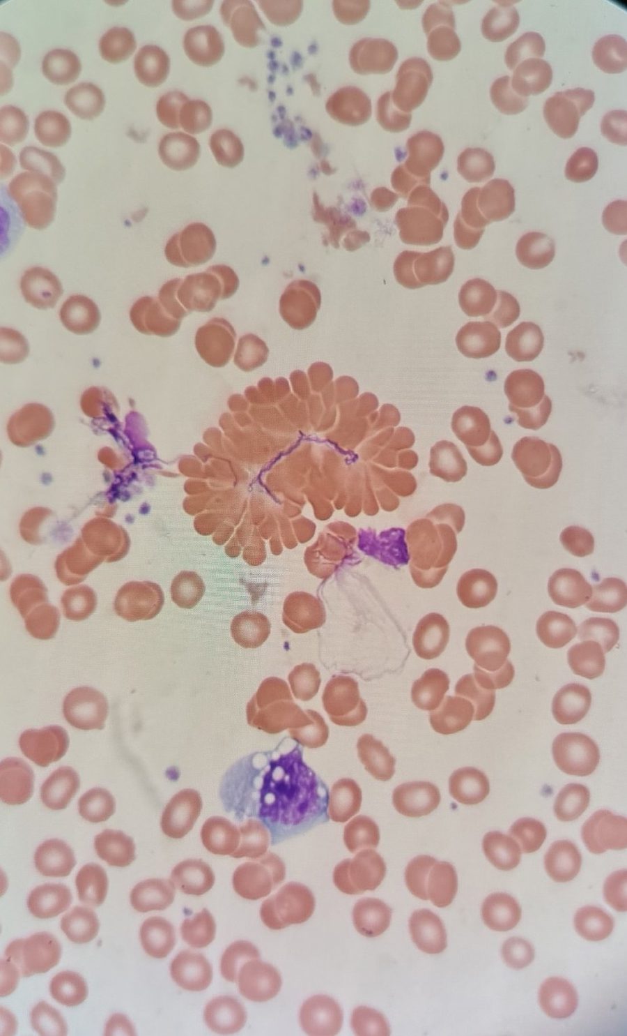 Radial Aggregation of Red Blood Cells in Peripheral Blood Smear