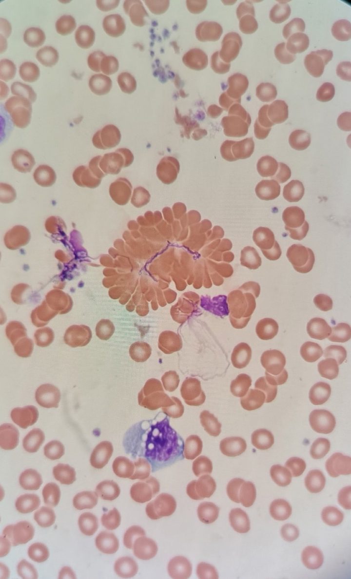 Blood smear: radial aggregation of red blood cells in a rosette shape around an artifact