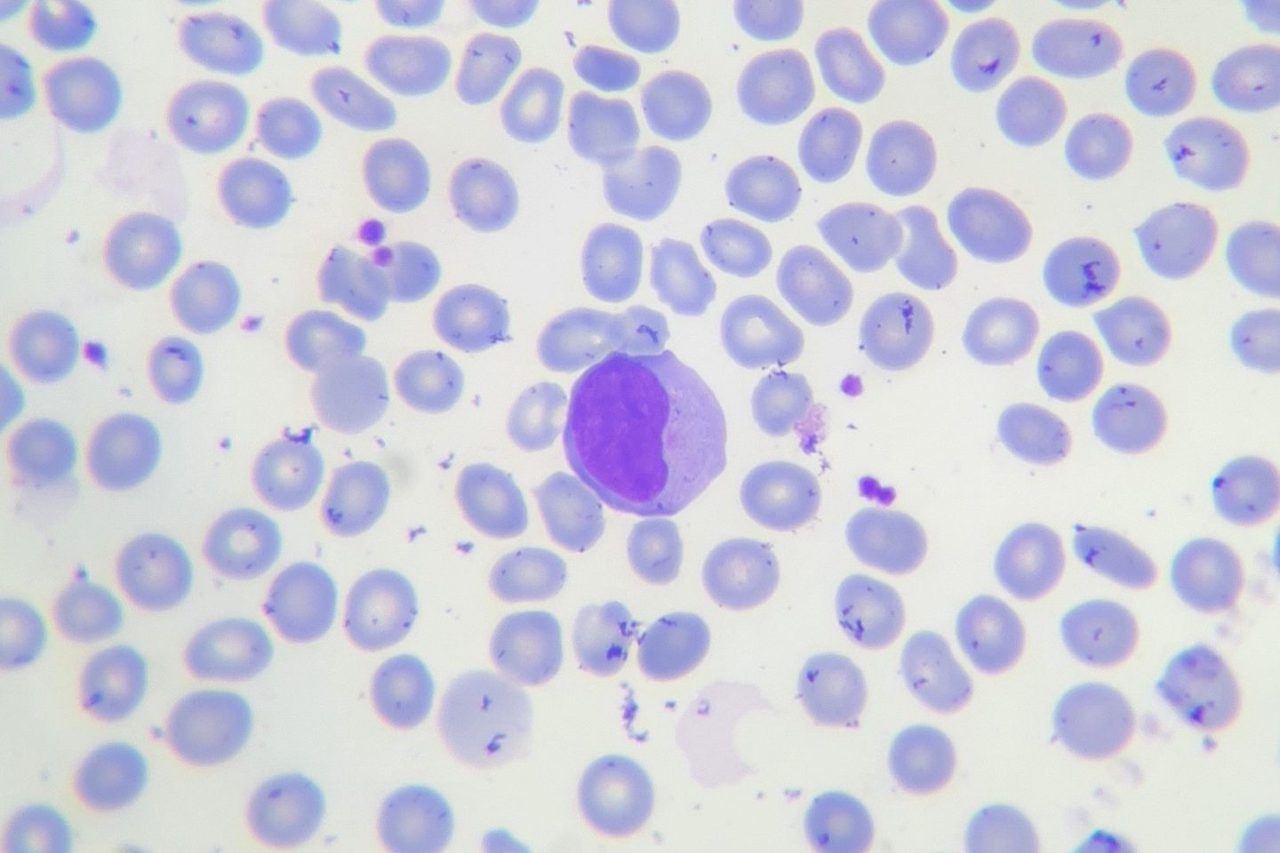 Reactive Lymphocytes & Atypical Mononuclear Cells in Blood Smear