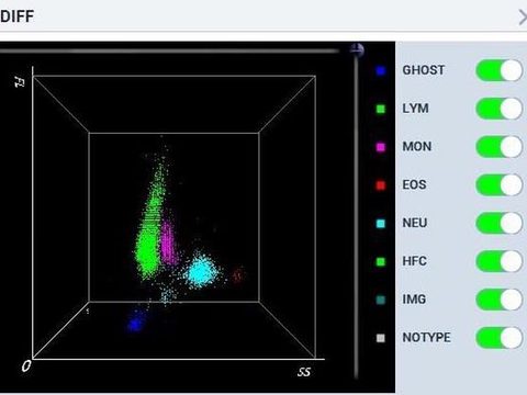 3D-скаттерограмма канала DIFF анализатора Mindray при коинфекции ВЭБ и цитомегаловируса