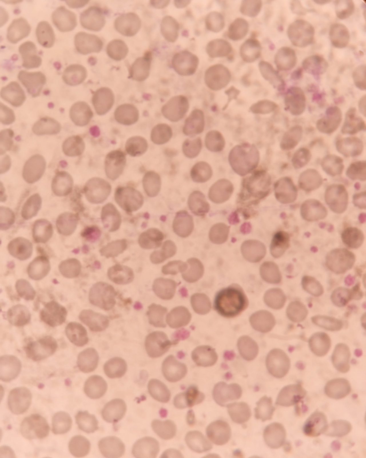 Reactive Thrombocytosis in Rheumatoid Arthritis