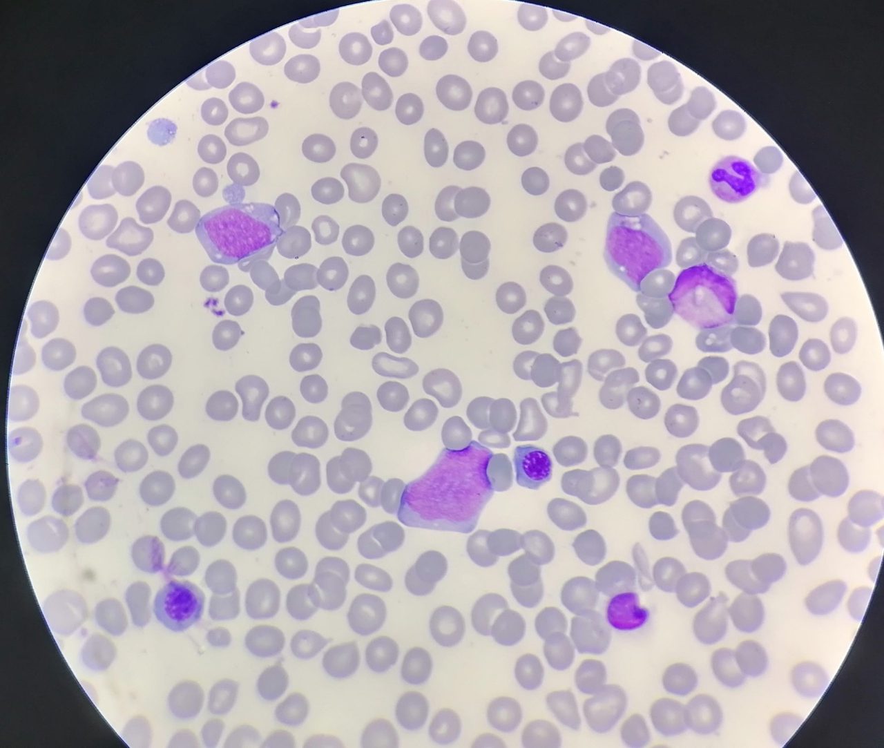 Acute Leukemia Relapse in Bone Marrow Smear