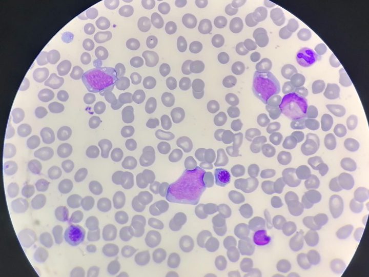 Bone marrow smear: blast cells with delicate chromatin and nucleoli, normoblasts