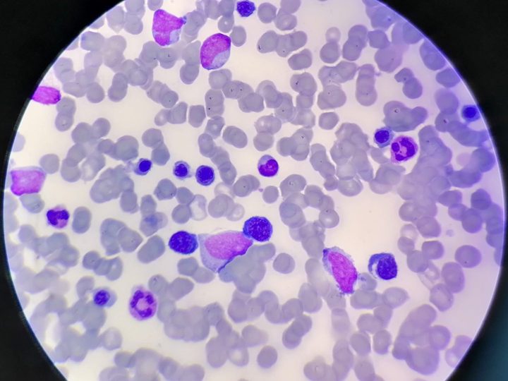 Bone marrow smear: blasts and hyperplastic erythroid lineage with normoblasts