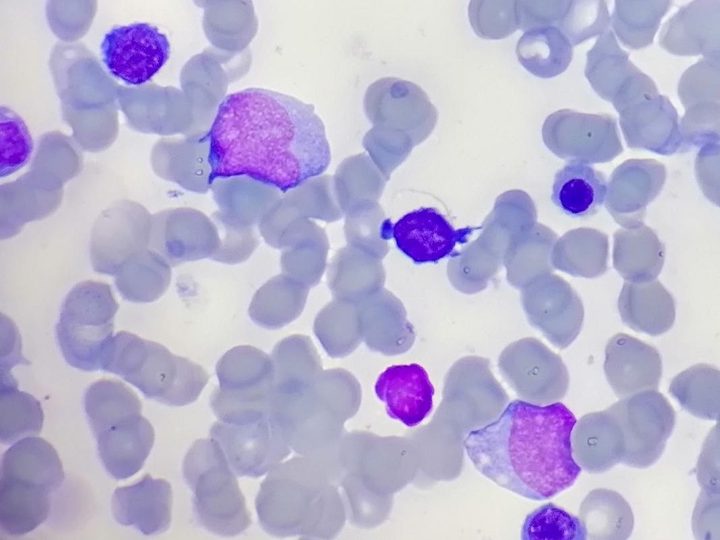 Bone marrow smear: close-up of blast cells and nucleated erythroid elements