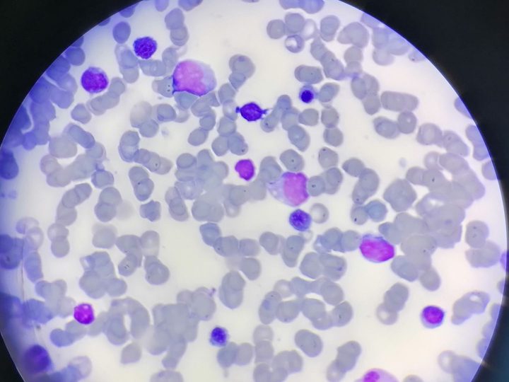 Bone marrow smear: blasts against the background of marked erythroid hyperplasia
