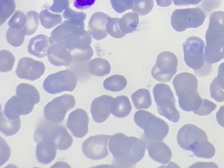 Bone marrow smear: large blast with basophilic cytoplasm and maturing granulocyte
