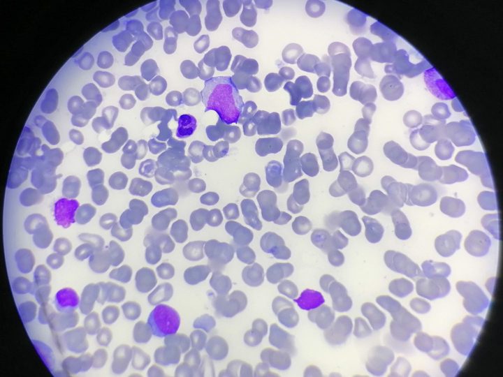 Bone marrow smear: blast cell and erythroid lineage elements of different maturity