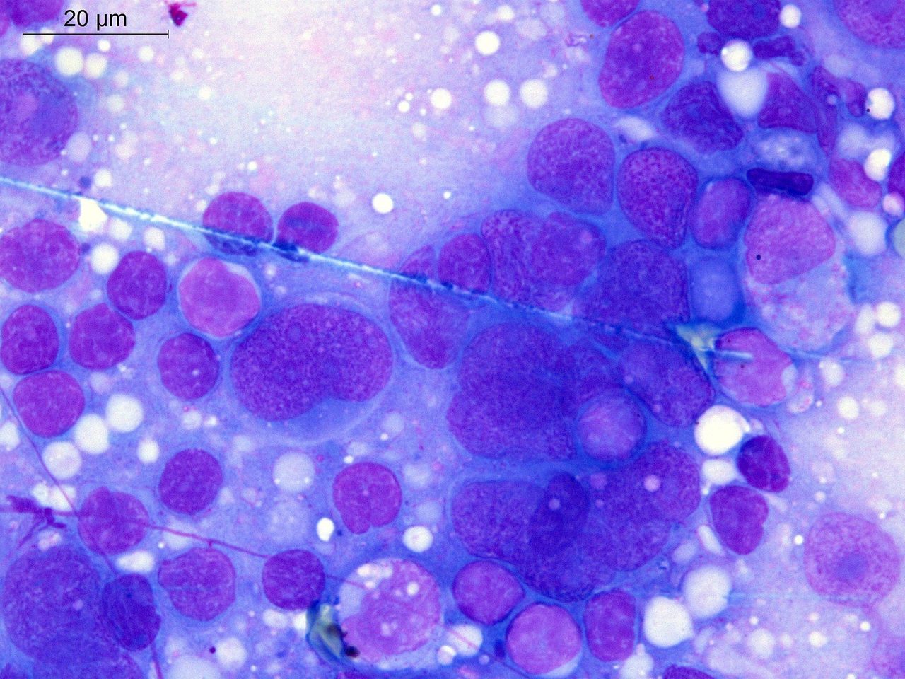 Follicular Dendritic Cell Sarcoma: Cytology of a Rare Tumor