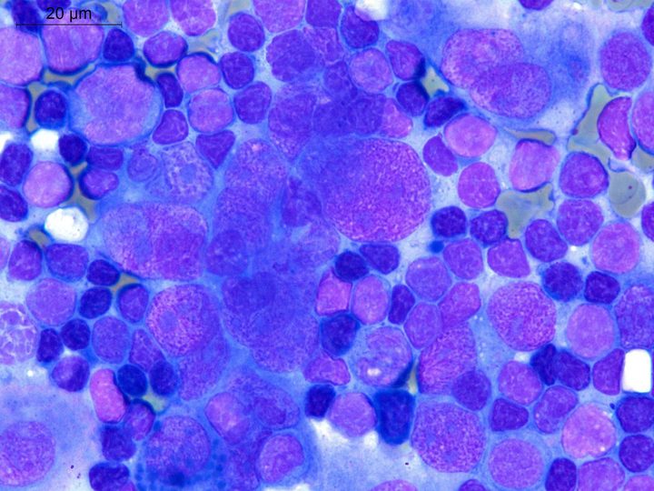 Lymph node touch imprint: syncytial cluster of FDCS cells with vesicular chromatin