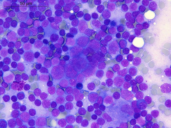 Lymph node touch imprint: cluster of atypical cells among small lymphocytes (50 µm)