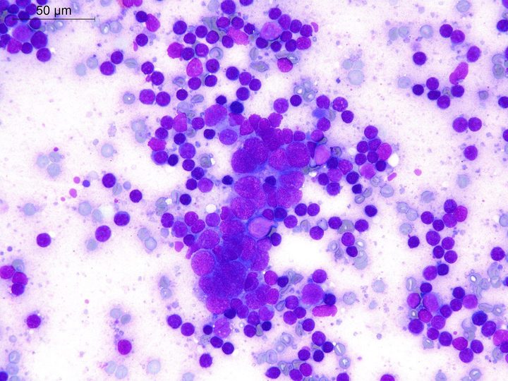 Lymph node touch imprint: sheet of polygonal tumor cells against a lymphoid background