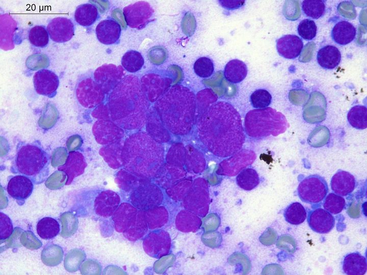 Lymph node touch imprint: group of large cells with abundant cytoplasm (scale 20 µm)