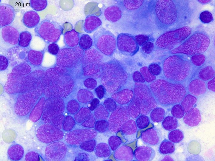 Lymph node touch imprint: pronounced nuclear polymorphism of sarcoma cells at high magnification