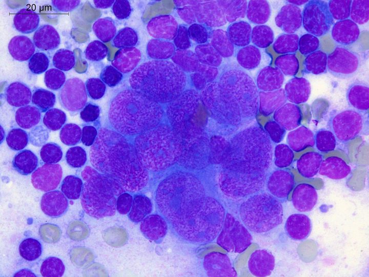 Lymph node touch imprint: tightly apposed tumor cells with indistinct borders